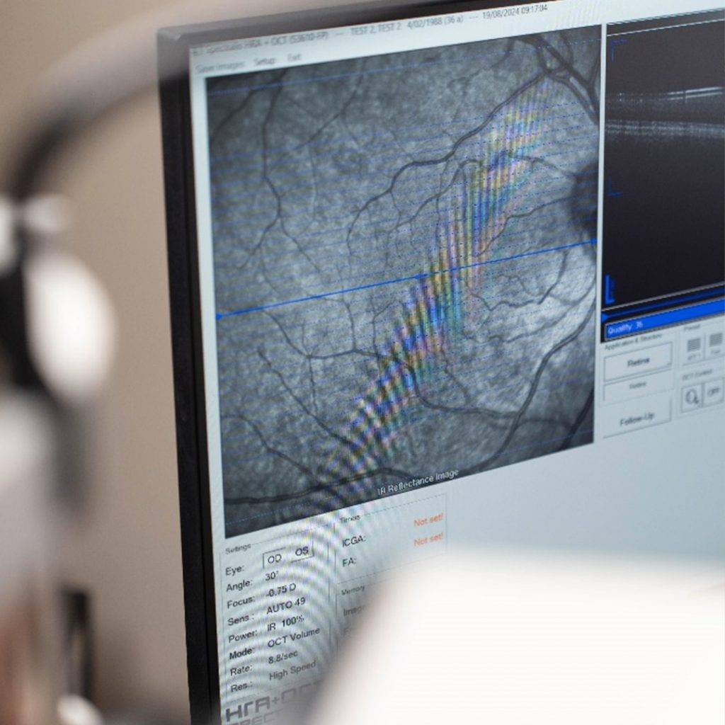 Examen OCT en Oftalmosur Arequipa, proporcionando diagnósticos de alta precisión con tecnología avanzada para cuidar tu salud ocular.